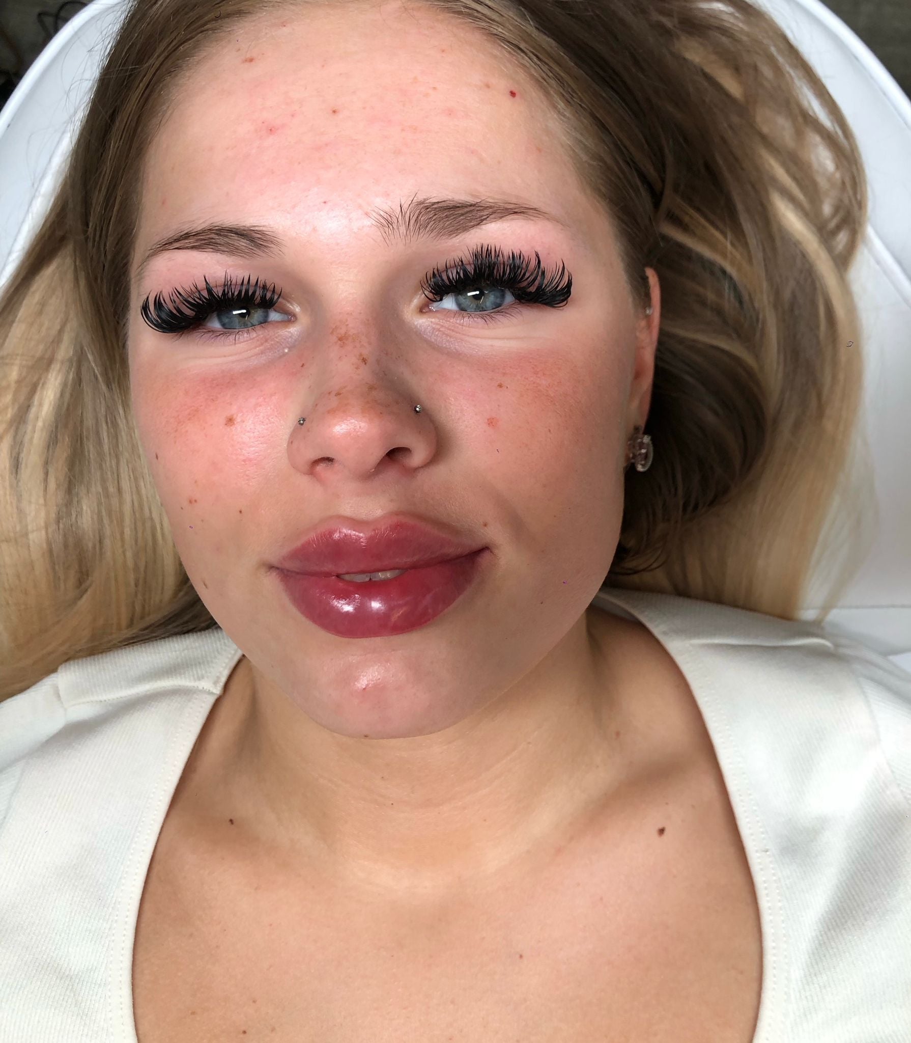 Dermal Fillers treatment